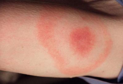 Cdc photo of lyme disease bullseye rash